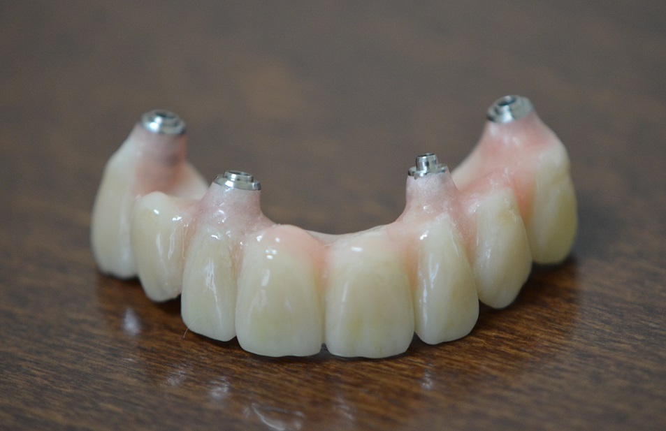 Dental-Implant-Bridge