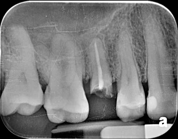 Snapped upper right premolar with root canal