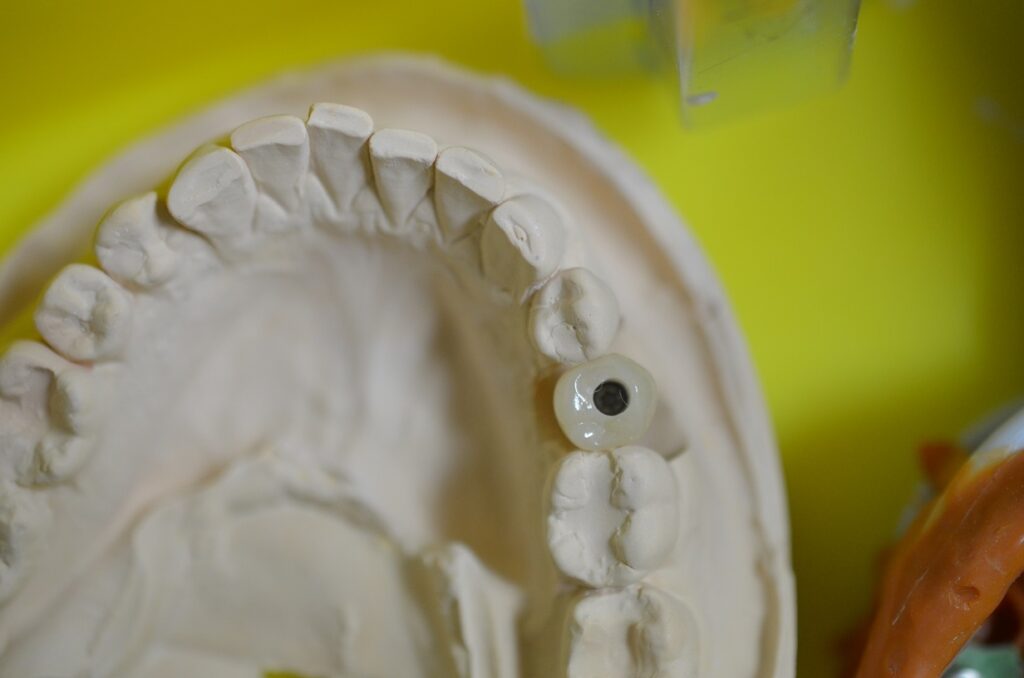 Premolar-implant-crown