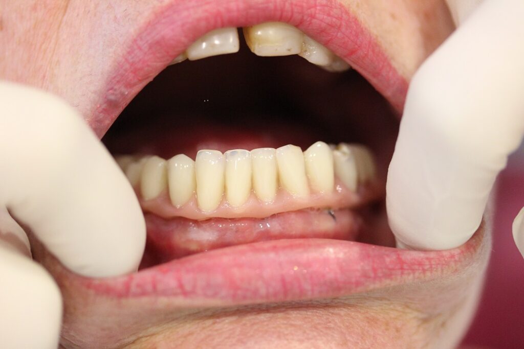 full-arch-dental-implant-2